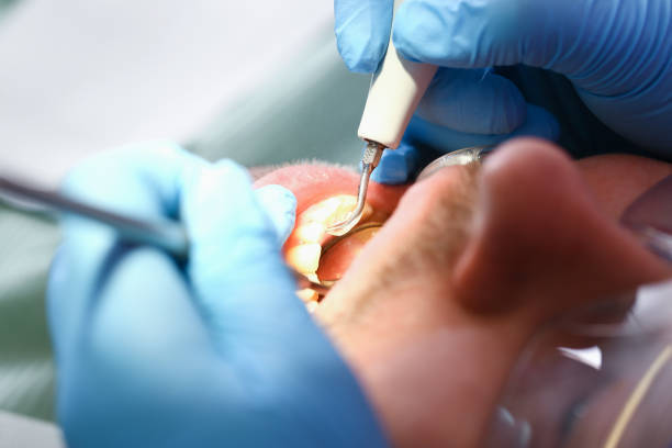 Best Emergency Tooth Extraction in Ivins, UT