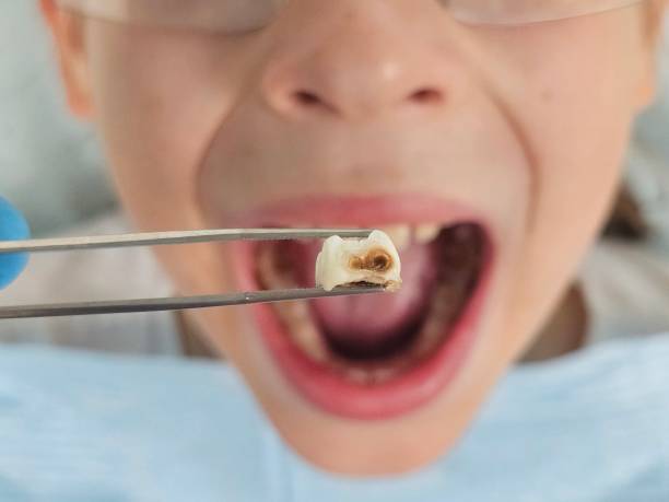 Best Emergency Broken Tooth Repair in Ivins, UT