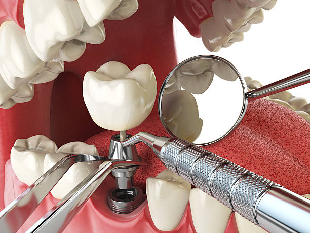 Best Emergency Wisdom Teeth Removal in Ivins, UT